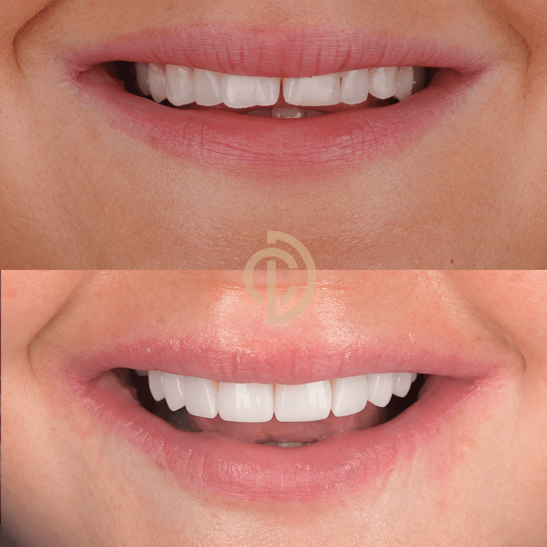 Jo’s Unbelievable Smile Makeover