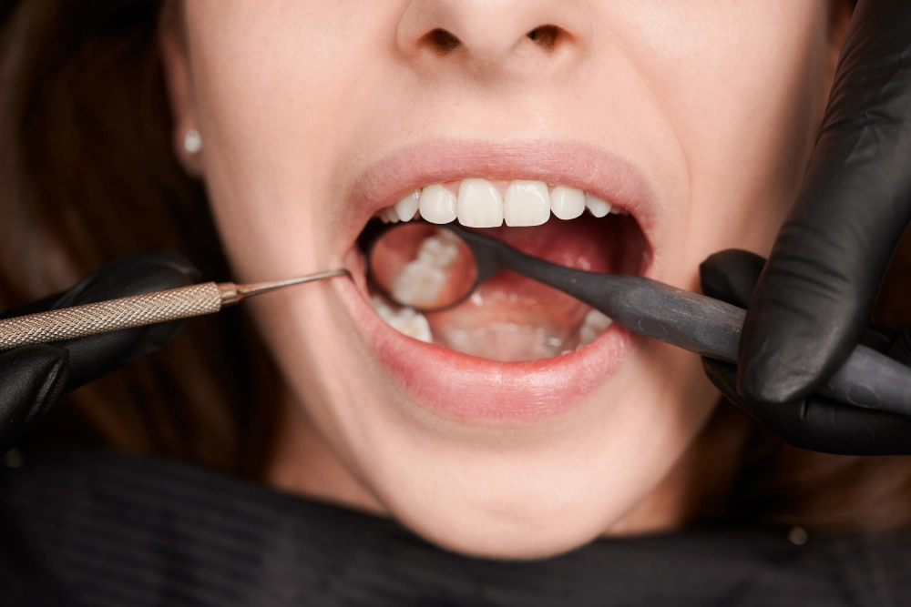 What Teeth Are Not Suitable for Composite Bonding?