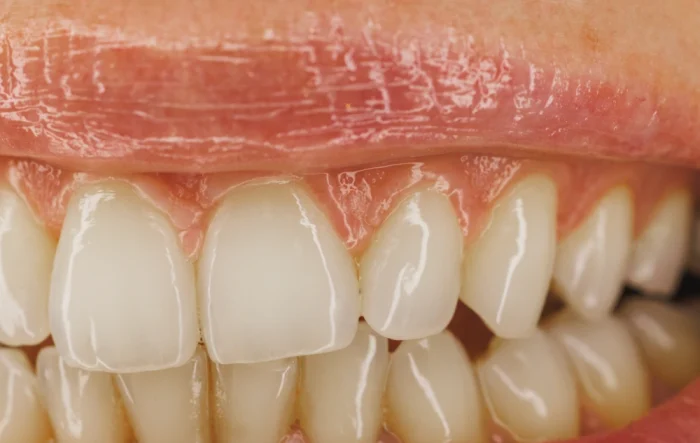 How Many Teeth Can You Get Composite Bonding On
